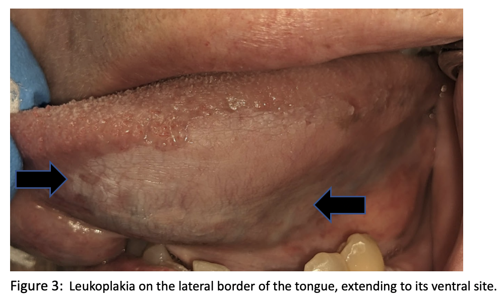 ventral buccal mucosa tongue