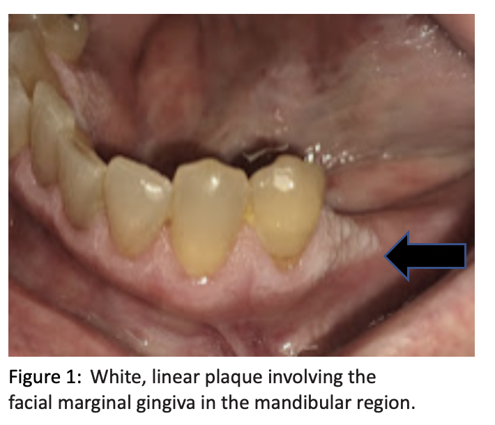 White, linear plaque involving the facial marginal gingiva in the mandibular region