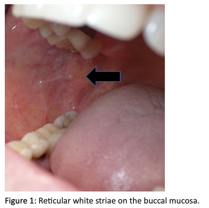 Reticular white striae on the buccal mucosa
