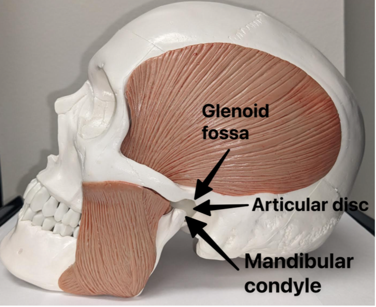 Anatomy model showing the temporal and masseter muscle with black arrows pointing to the mandibular condyle, articular disc, and glenoid fossa.