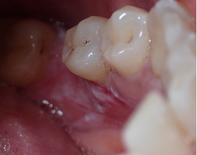 Clinical presentation of Erosive Lichen Planus on the left lingual gingiva of the mandibular teeth.