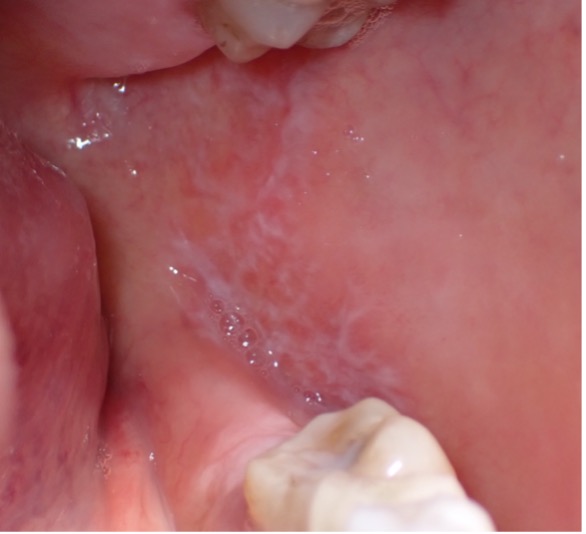 Patient presenting bilateral reticular lesions typical of oral lichen planus; in addition, some erosive lesions appear in the left buccal mucosa.