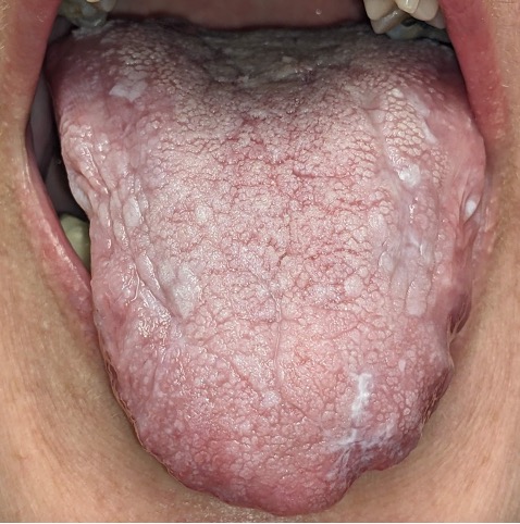 A patient presented with plaque-like lesions on the dorsal tongue and biopsy-proven lichen planus.