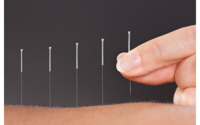 Is Acupuncture an Excellent Option to Help with Chronic Neck Pain?