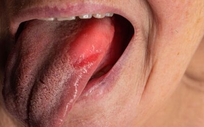 Over-the-Counter Supplements for Burning Mouth Syndrome