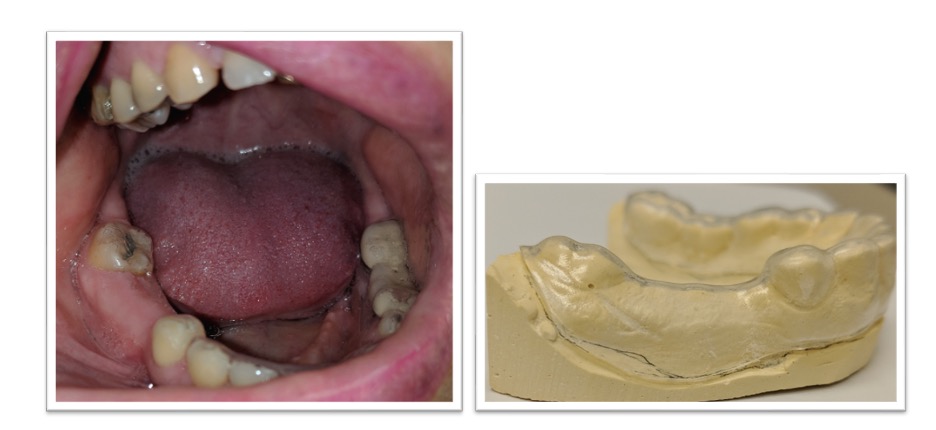 side of mouth open to display teeth and a mold imprint with a retainer to the right of it. 