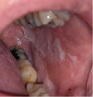 Oral epithelial dysplasia (OED) on the left buccal mucosa