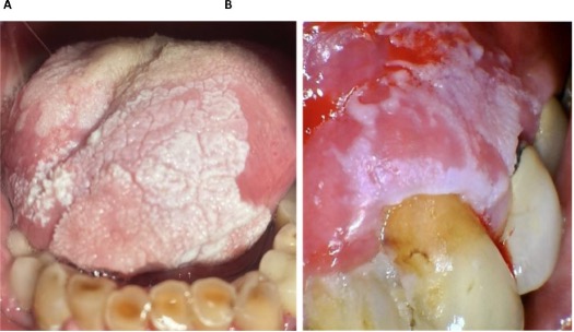 A) 81-year-old male with a history of PVL and biopsy proven dysplasia of the tongue. (B) 69-year-old female with PVL of the left maxillary gingiva and biopsy proven dysplasia with SCC transformation