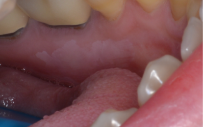 Early Detection of Oral Pre-Cancer