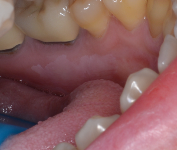 Leukoplakia (biopsy proven mild epithelial dysplasia) on the left lingual side of mandible.