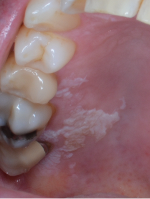Leukoplakia (biopsy proven mild epithelial dysplasia with PVL features) on the right side of hard palate.