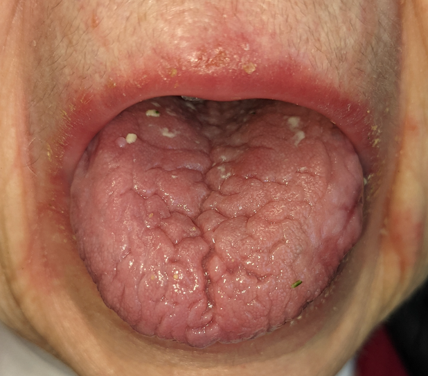 Cancer patient with severe dry mouth, candidal infection intraoral and extraoral.