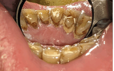 Oral Hygiene and Oral Cancer