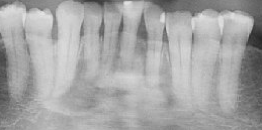 Part of a panoramic radiograph showing cemento-osseous dysplasia in the mandible with the mixed radiopaque and radiolucency diffuse appearance periapical to teeth.