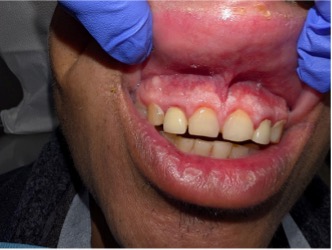 Oral Fungal Infections in Diabetic Patients