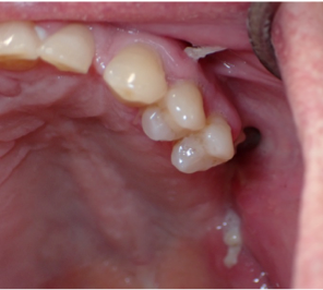 Invasive oral fungal infection (mucormycosis) of the left posterior maxilla in uncontrolled diabetes, demonstrating advanced tissue necrosis and Angio invasive disease.